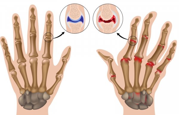 Артрит пальцев рук: симптомы, опасность заболевания, лечение