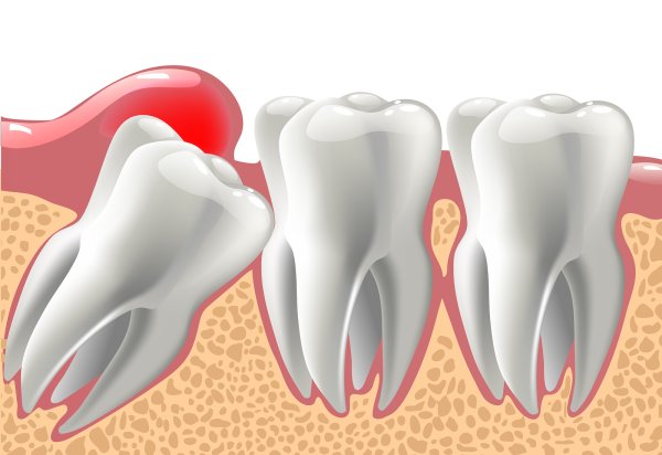 Удаление зуба мудрости: Удалять или нет? Как проходит операция, срок заживления, рекомендации по уходу