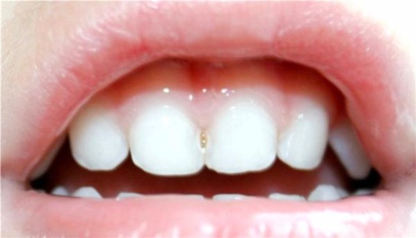 Все о молочных зубах: рождение, фаза обмена и уход