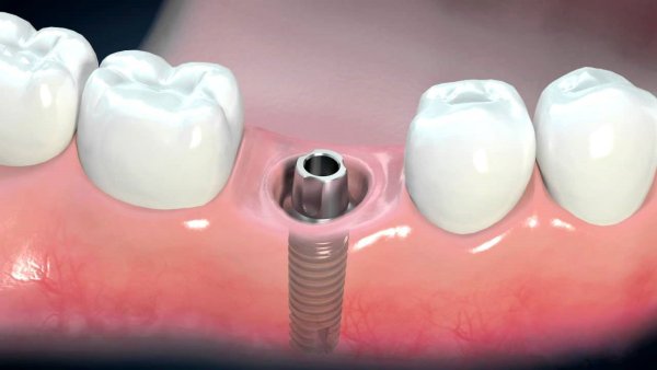 Одноэтапная имплантация зубов: быстрый результат и минимальный травматизм