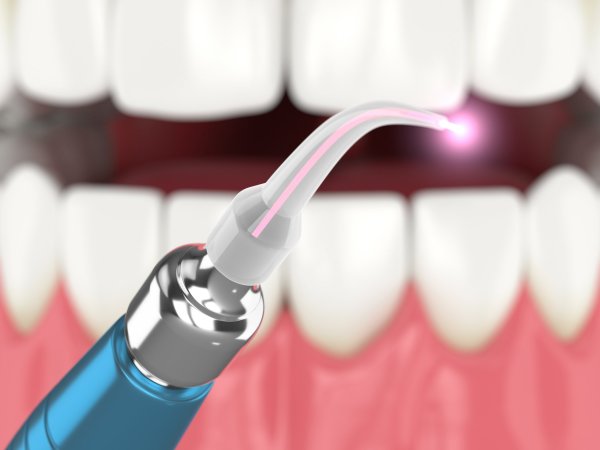 Лазерная стоматология: безопасный и эффективный способ лечения зубов