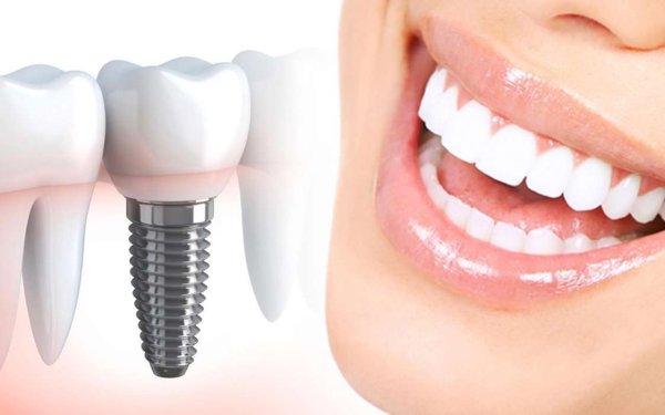 Имплантация при полном отсутствии зубов: восстановление улыбки и качества жизни